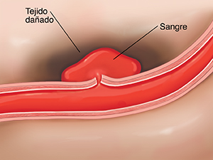 Corte transversal de una arteria rota en el cerebro que causa un accidente cerebrovascular hemorrágico. 